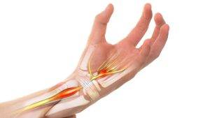 سندرم تونل اولنار چیست