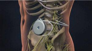 پمپ اینتراتکال