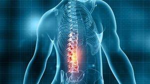 سندرم جراحی ناموفق کمر (FBSS)