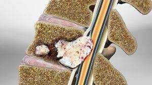 تومور نخاعی