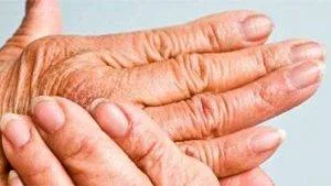 آرتریت موتیلان