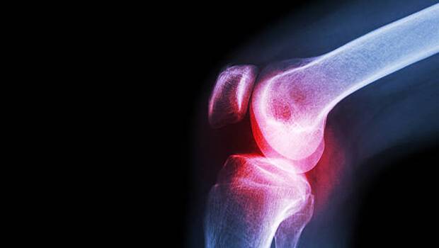 تشخیص آرتریت سپتیک