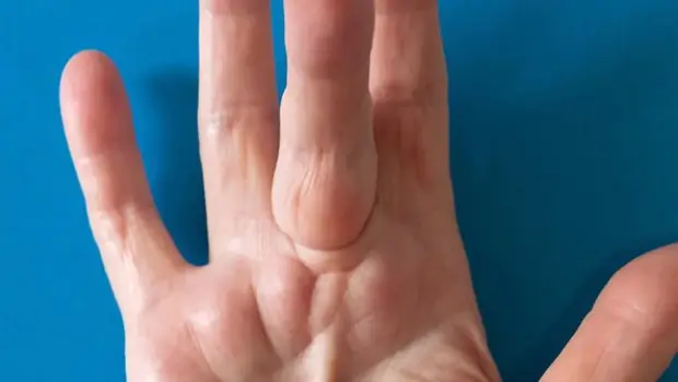 انقباض دوپویترن