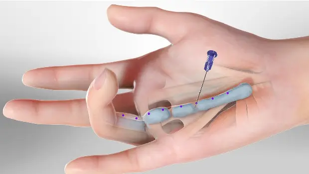 علائم انقباض دوپویترن
