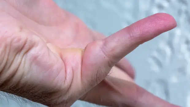 انقباض دوپویترون چیست