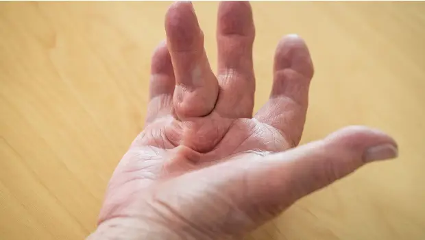 علت انقباض دوپویترون