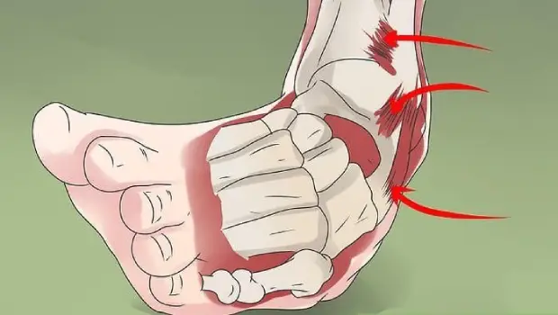 علائم پیچ خوردگی مچ پا