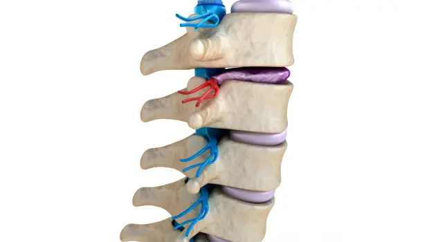 علائم دژنراتیو دیسک کمر