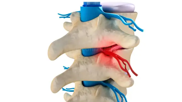 علت دژنراتیو دیسک کمر