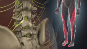 درد اعصاب به کجا میزند