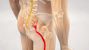 بهترین آمپول برای درد سیاتیک