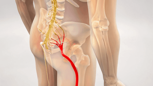 بهترین آمپول برای درد سیاتیک