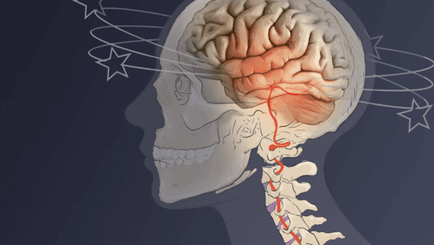 دیسک گردن و سرگیجه