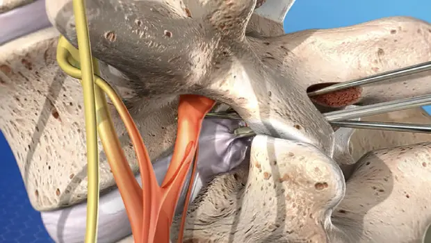 عوارض آندوسکوپی دیسک کمر