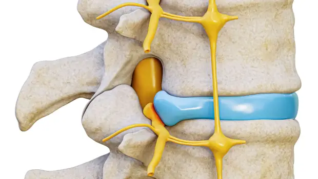 آندوسکوپی دیسک کمر