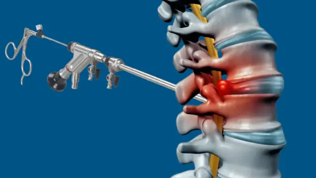 معایب آندوسکوپی دیسک کمر مهره 4 و 5