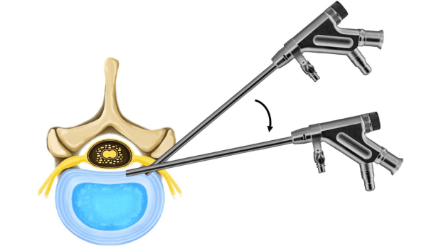عوامل موثر در هزینه آندوسکوپی دیسک کمر