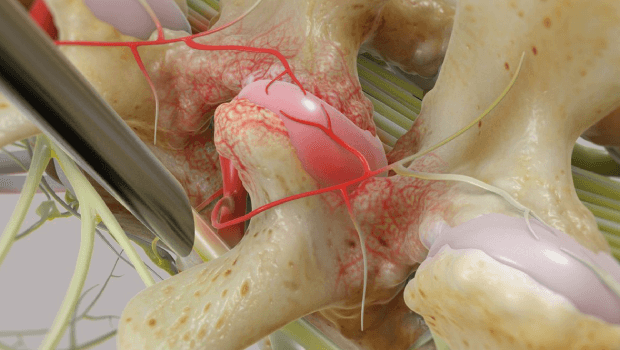 هزینه عمل دیسک کمر