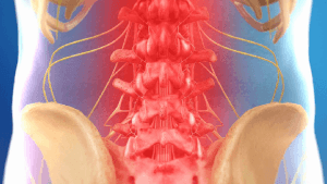 هزینه عمل دیسک کمر با لیزر