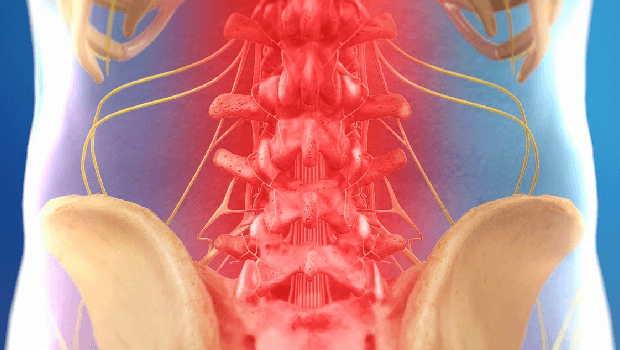 هزینه عمل دیسک کمر با لیزر