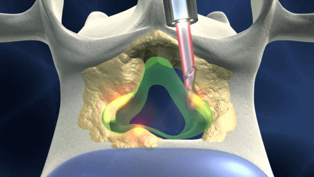 هزینه عمل دیسک کمر ۱۴۰۴