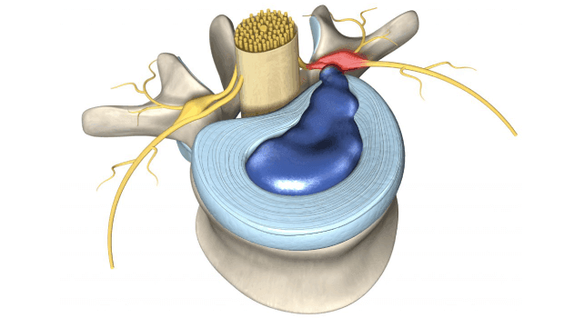 هزینه عمل دیسک کمر با لیزر در تهران