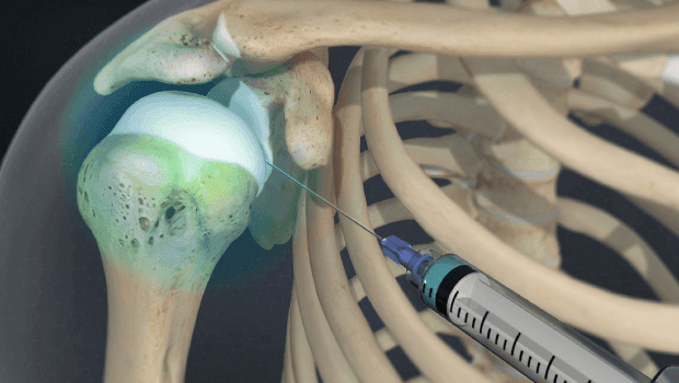 تزریق داخل مفصل شانه