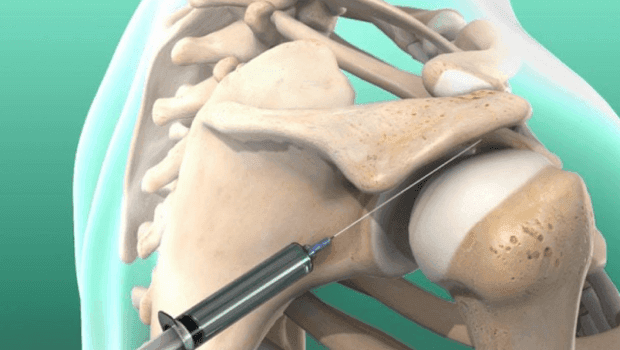 هزینه تزریق شانه