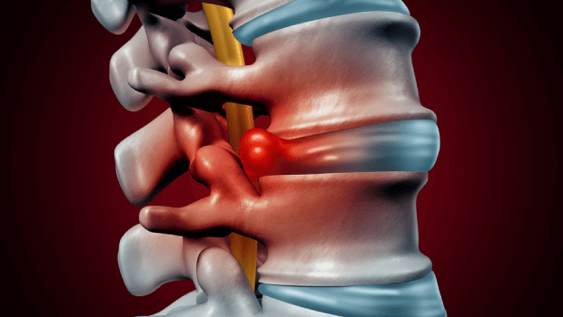 نشستن بعد از عمل دیسک