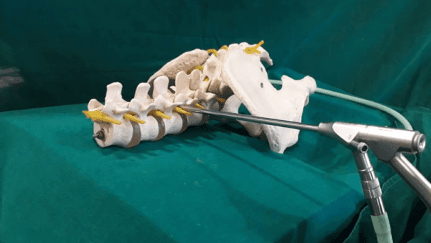 عمل آندوسکوپی دیسک کمر