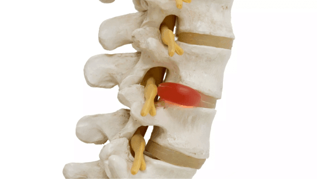 فیزیوتراپی بعد از دیسک