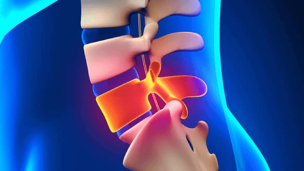 مراقبتهای بعد از عمل آندوسکوپی دیسک کمر