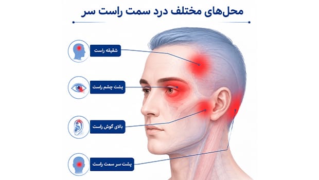 محل‌های مختلف درد سمت راست سر شامل شقیقه، پشت سر، بالای گوش و پشت چشم