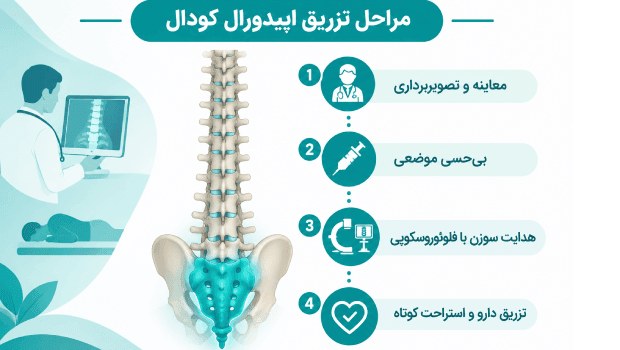 مراحل تزریق کودال