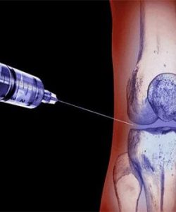 Stem cell injection Stem cell injection